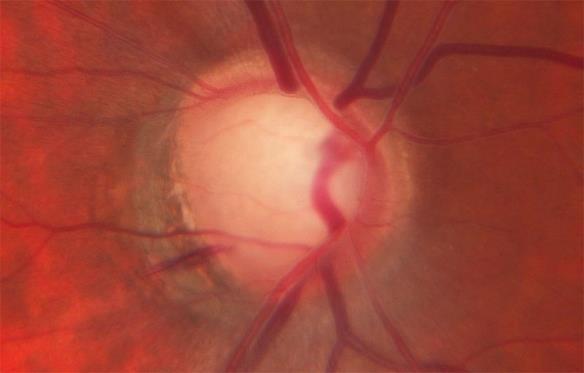 com/glaucoma/ typisch für das Glaukom ist, dass der Sehnervenkopf im Auge verstärkt aufgrund des druckbedingten Absterbens von Nervenfasern