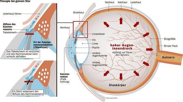 bereits ein niedriger Augeninnendruck zum Fortschreiten eines Glaukoms führen gesunder Sehnerv ohne zentrale Auslösung (Excavation) Sehnervenkopf