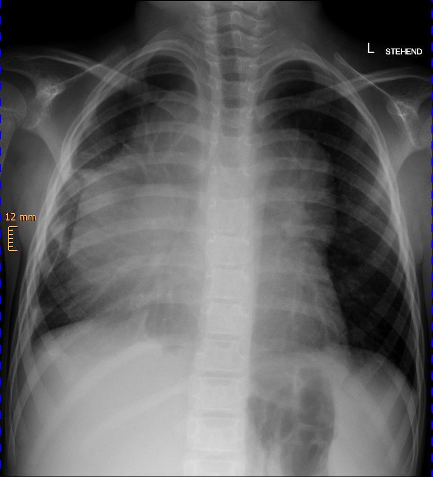 Fall 2 - Diagnostik Röntgen-Thorax: Ausgedehnte