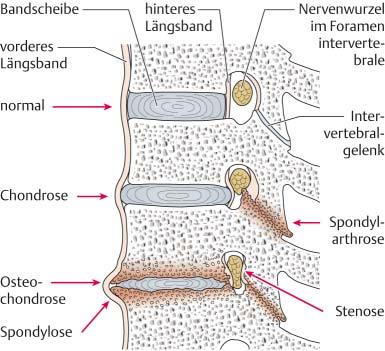 .3 Degenerative Erkrankungen der Wirbelsäule 235 Wirbelkörpern: die Grund- und Deckplatten sklerosieren verstärkt (Osteochondrose), ferner bilden sich knöcherne Ausziehungen, Randzacken und -wülste