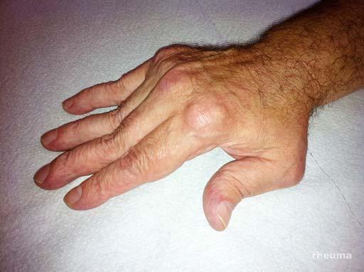 Spätstadium einer Rheumatoiden Arthritis Hyperextension PIP, Hyperflexion DIP= Schwanenhalsdeformität,