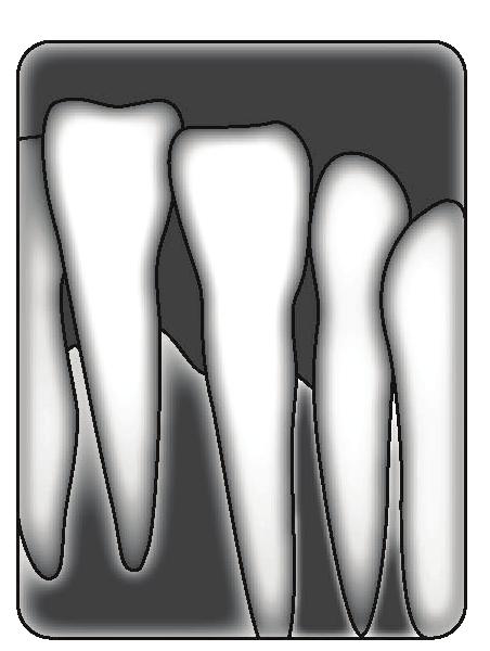 d) Zahn 34 mesial kann nicht diagnostiziert werden. Aufgabe 8 (8.3.8 / K) Ordnen Sie die dargestellten Zentralstrahlausrichtungen der Halbwinkeltechnik dem passenden Röntgenbild zu.