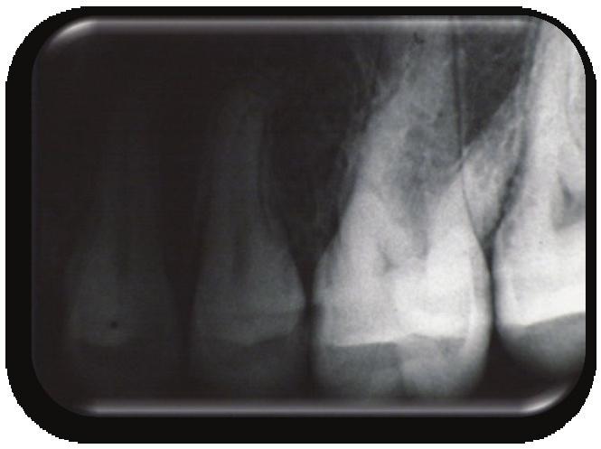 maimal erreicht Übertrag 3 Aufgabe (8..4 / K3) Das abgebildete Röntgenbild ist in der Gegend der Prämolaren zu dunkel und kann für eine Diagnose kaum verwendet werden.