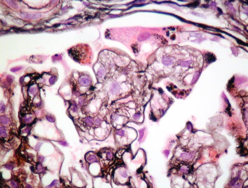 Glomerular TMA definitions Mesangiolysis: Dissolution of the mesangial matrix, identified by reduced staining with matrix stains