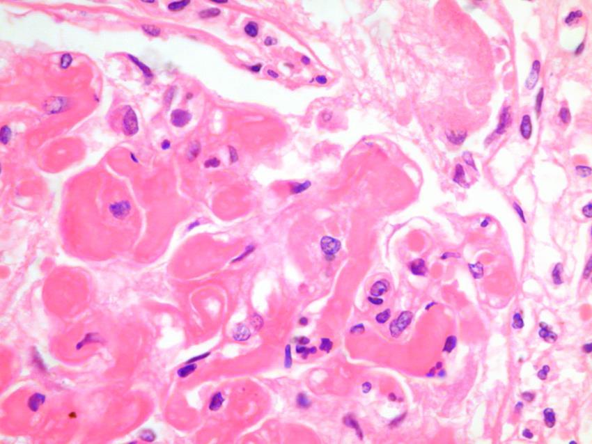 Glomerular TMA definitions Glomerular thrombosis: occlusion of glomerular capillaries by fibrin or platelet rich thrombi.
