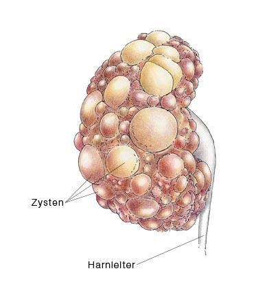 Nierenbeckenentzündung Zysteninfektion