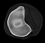 Diagnostische Bildgebung Computertomographische US Sensitiver als Röntgen 9/42 Zysten nur im CT