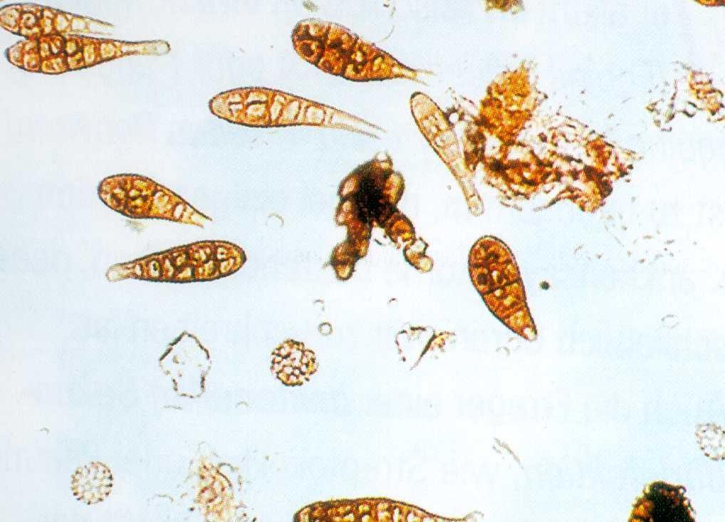 4) Ursachen / Diagnose B) nicht infektiös: Allergien auf Pilzsporen (Vermehrungsformen der Pilze)