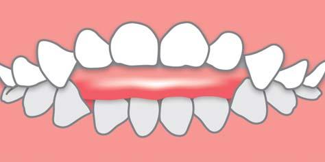 Beißen die Schneidezähne nicht wie eine Schere übereinander und besteht zwischen den oberen und unteren Zähnen ein mehr oder weniger großer Abstand, spricht man von einem frontal-offenen Biss.