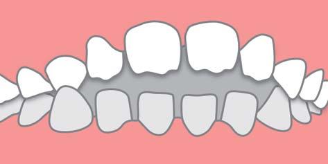 Umfangreichere Zahnbewegungen sind jedoch begrenzt und mit den Möglichkeiten herausnehmbarer oder festsitzender Zahnspangen nicht vergleichbar.