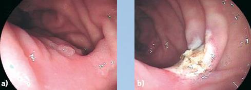 Tumorablation Duodenal