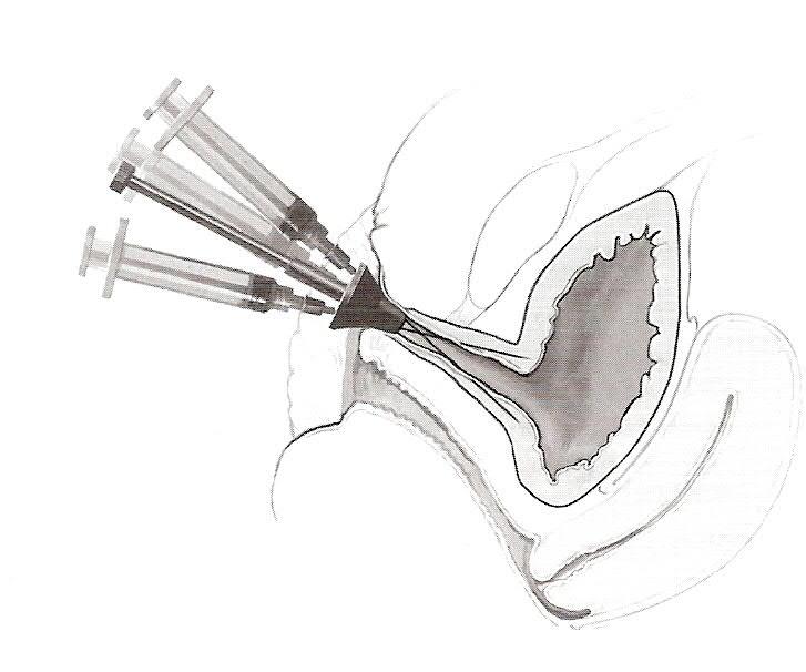 Verfahren zur Einengung von Blasenhals/Schließmuskel Unterspritzung Unterspritzen von