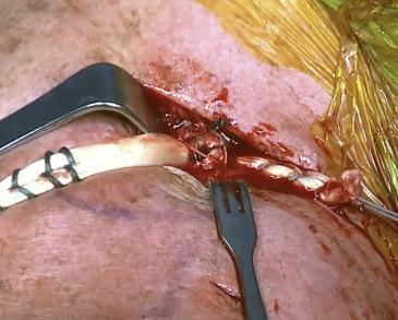 Fig 8 Arthroscopically Assisted Anatomic Coracoclavicular Ligament Reconstruction Technique Using Coracoclavicular Fixation and Soft- Tissue Grafts Peter J. Millett, M.D., M.Sc., Ryan J. Warth, M.D., Joshua A.