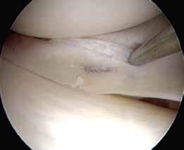 2 3 4 5 LEGENDE 2 Arthroskopische Sicht auf einen verletzten Innenmeniskus Knie rechts 3