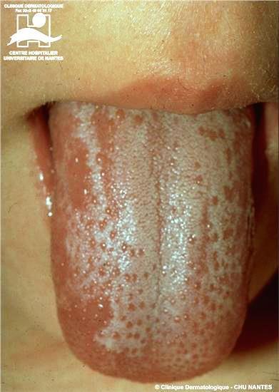Blickdiagnose Hautrötung Aussparung der Mundpartie Schuppung der Haut Mandel- / Rachenentzündung Rötung der