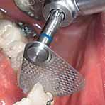 Orthodontics Oscillating segment discs Oscillating