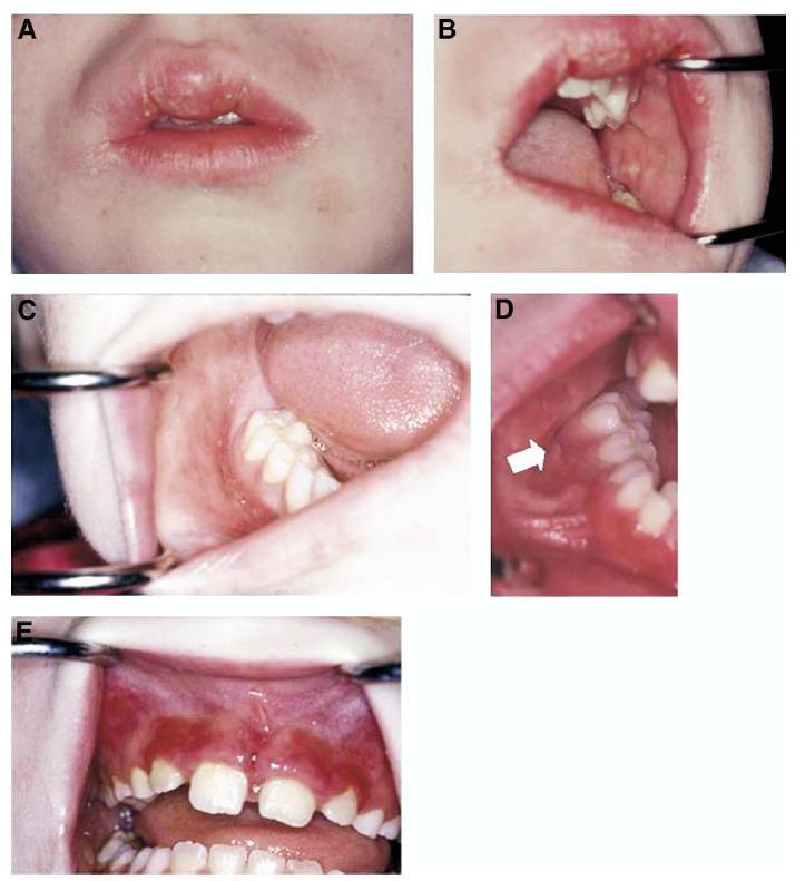 (A) Lip swelling with fissures (B) Cobblestone appearance of the buccal mucosa (C) Linear ulceration deep in the mandibular vestibule (D) Mucosal tag on the buccal aspect of the gingiva (E)