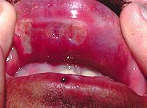 Verlauf 4 Wochen später: Weiterhin Aphthen / kleinere Ulcerationen oral, Lippenschwellung. Ausgeprägtes Krankheitsgefühl. Verdachtsdiagnosen? M. Behçet M.