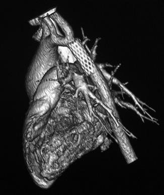 Computertomo-graphie / Angiographie 12 Monate nach der Stentimplantation in die Aorta. Der Patient hat normale Blutdruckwerte.
