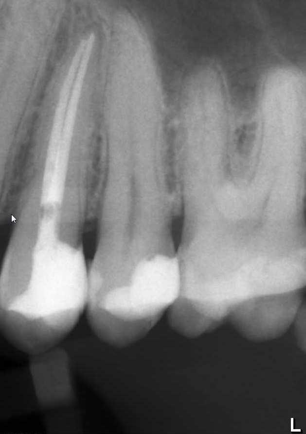 Seite 4 von 5 - Bei stark zerstörten Zahnkronen mit erheblich geschwächten Zahnwänden kann das Einkleben eines Glasfaserstiftes in einen der Kanäle zur endodontischen Stabilisierung notwendig sein.
