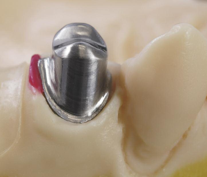 Da wir im Gaumenbereich des Modells weniger Masse vorfinden als im Bereich des Zahnkranzes oder der Kieferkämme, ist es sinnvoll, das Meistermodell vor dem Dublieren zu unterfüttern (Abb. 6).