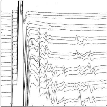 41 SM A 1 2 3 4 5 6 7 0,2 mv Abbildung 14. Multiple A-Wellen: Einfluss der Stimulusintensität. N. tibialis; Patientin mit GBS 4 Tage nach Symptombeginn. Unterschiedliche Reizschwellen für A-Wellen.