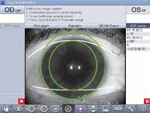 Damit stehen alle Daten für eine präzise und markerlose Positionierung der torischen IOL in Farbe und hoher Auflösung dort zur Verfügung, wo sie benötigt werden im Okular