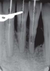Tulus/Schulz-Bongert Ultraschallaktivierte Spülung bei endodontischen Behandlungen 3 Abb. 1 Ausgangssituation des ersten Falls: Röntgenmessaufnahme vom ersten Behandlungstag.