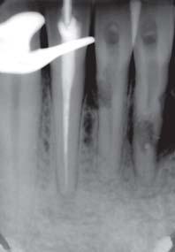2 Kontrollaufnahme nach Wurzelkanalfüllung des Zahns 42. tionsmikroskop (= OPM; Karl Kaps, Asslar) war nicht möglich, da der Einblick durch nekrotisches Gewebe im Kanal verhindert wurde.