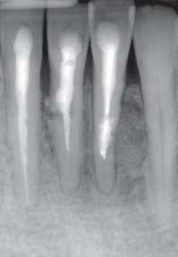 Tulus/Schulz-Bongert Ultraschallaktivierte Spülung bei endodontischen Behandlungen 5 Abb. 5 Situation unmittelbar nach Zystektomie distal von Zahn 31 und Auffüllung des Knochendefekts mit BioOss. Abb. 6 Röntgenkontrolle etwa fünf Monate nach der Zystektomie.
