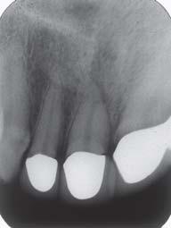 Tulus/Schulz-Bongert Ultraschallaktivierte Spülung bei endodontischen Behandlungen 7 Abb. 9 Dritter Fall: Endodontisch anbehandelter Zahn 11.