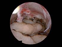 _ Hysteroskopie (Operative Gebärmutterspiegelung) Submuköse e (in Nähe der Gebärmutterhöhle) können durch Gebärmutterspiegelung (Hysteroskopie) von der Scheide aus entfernt werden (Abb. 5).