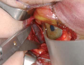 Trans-/retrokarunkulärer (= medial transkonjunktivaler) Zugang; C Untere Fornix-Inzision mit lateraler Hautschnitterweiterung (laterale Kanthotomie/Swinging Eyelid).