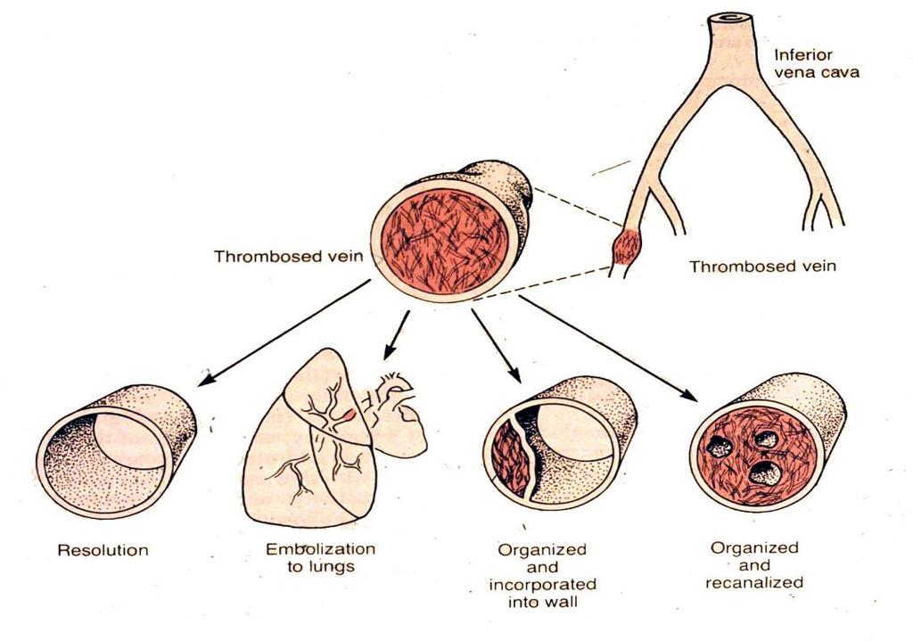 Verlaufsformen eines Thrombus Propagatio