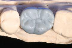 Ziel ist es, das Zahnfleisch so zu formen, dass die Krone wie ein natürlich aus dem Zahnfleisch herausgewachsener Zahn aussieht.