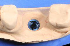 Modell mit Emergenzprofil Vollkeramikkrone auf dem Modell Implantat-Suprakonstruktionen Bei der Versorgung von Implantatpatienten mit Zahnersatz gibt es zahlreiche Alternativen.