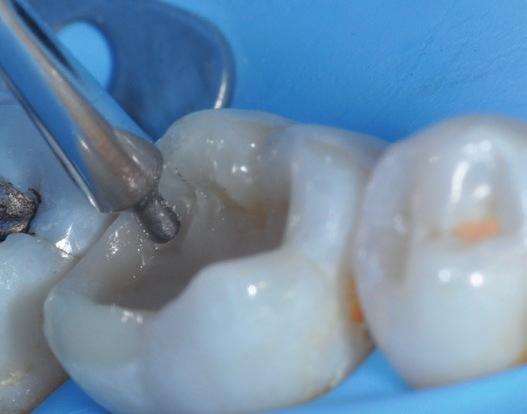 Die gabelförmige Instrumentenspitze ermöglicht die Modellierung der Approximalwände, um die Höhe und Anatomie des benachbarten Zahns mithilfe einer Matrize