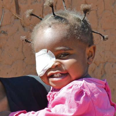 Wir setzen uns für Augengesundheit in Afrika, Asien, Lateinamerika und Ozeanien ein. In Mosambik haben 2017 fünf AugenärztInnen ihre Ausbildung abgeschlossen.