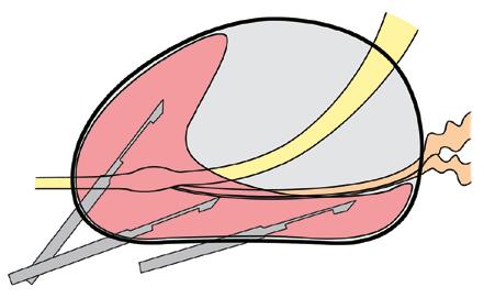 Sinnvoll ist die gezielte Gewebeentnahme zumindest aus den Risikozonen der Prostata, nämlich aus den seitlichen Bereichen der Basis, der Mitte und der Spitze der Prostata, jeweils rechts und links.