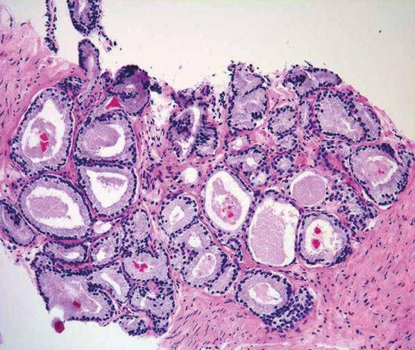 (siehe Abb. 8). Bei der feingeweblichen (histopathologischen) Untersuchung können normale von bösartigen Prostatazellen unterschieden werden.