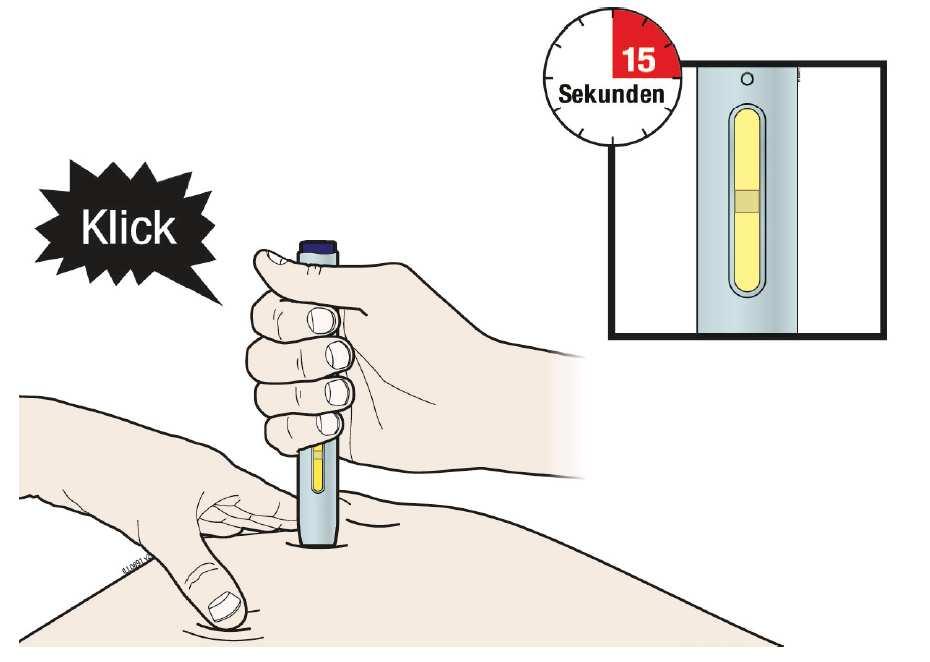 Schritt 3: Injektion (G) Halten Sie die Haut weiterhin gespreizt bzw. zusammengedrückt.