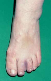 Zeh des linken Fußes vor (oberes Bild) und vier Wochen nach antibiotischer Therapie (unteres Bild). ist dieser Symptomenkomplex (Meningo polyradikuloneuritis, M.
