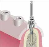 ARBEITSANWEISUNG BEGO GUIDE TRAYS 7 BEGO Guide Gewindeschneider (3-6) Mit dem Gewindeschneider bereiten Sie in der Kavität ein Gewinde für das zu inserierende Implantat auf.