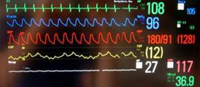 Monitoring Am Monitor CareScape: - EKG (Beispiel) - Arterielle Blutdruckmessung