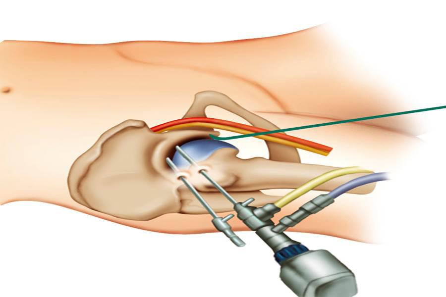 Allgemeine Informationen bezüglich der Operation Die Arthroskopie wird durch den technischen Fortschritt zunehmend auch am Hüftgelenk angewandt.