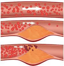 Statintherapie Das weiterbestehende kardiovaskuläre Restrisiko bei mit statinbehandelten PAVK - Patienten hängt unabhängig von Statindosis und Lipidwerten ab von Komorbidität (Hypertonie, (Diabetes