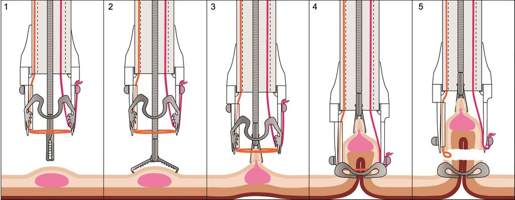 Full-thickness-resection-device