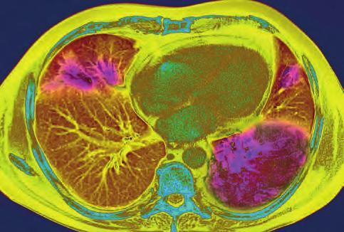 Kolorektalkarzinom: Frühes Ansprechen in PET-CT und CTC 7 Molekulares Profil birgt Chancen für Patienten mit Pankreas-Ca 8 Palliative partielle Gastrektomie mittels Hybridtechnik 8 ATEMWEGE