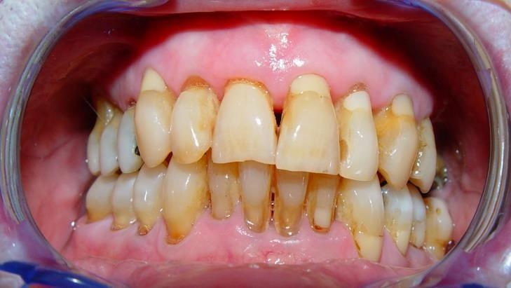 mehr durchgeführt, so können auch noch im hohen Alter kariöse Läsionen auftreten (siehe linkes Bild) eine gute Mundhygiene