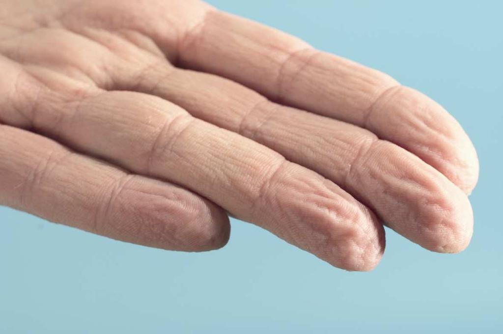 Hautbelastungen in der Pflege Zu langes Tragen von Handschuhen belastet die Haut in der Pflege!